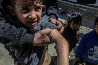 Filistin Sağlık Bakanlığından Gazze'de salgın hastalık uyarısı